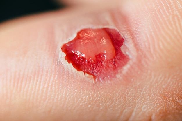 Red wound after a fall on a child's finger