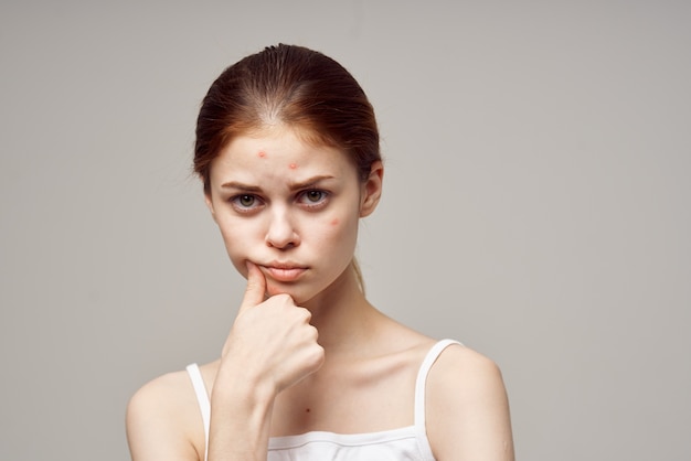 Redhaired woman with pimples on the face hygiene isolated\
background