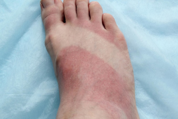 Photo redness of womans leg as result of skin burn foot soreness after a sunburn dermatology problems