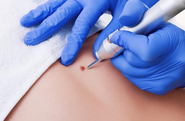 Removal of benign tumors in Cosmetic salon The use of liquid nitrogen in dermatology