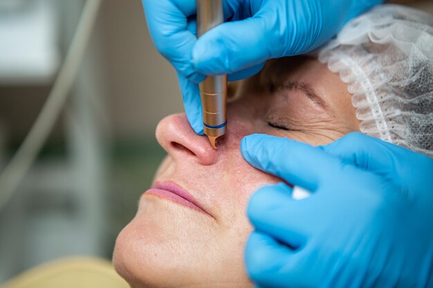 Removal of blood vessels by laser on the face of a Caucasian adult woman