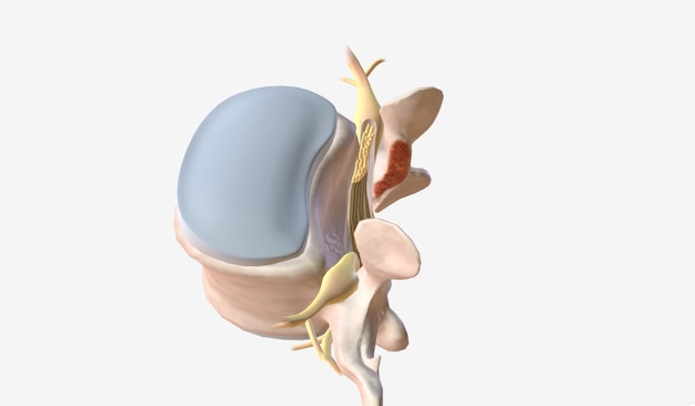 Removal of Excess Bone and Connective Tissue