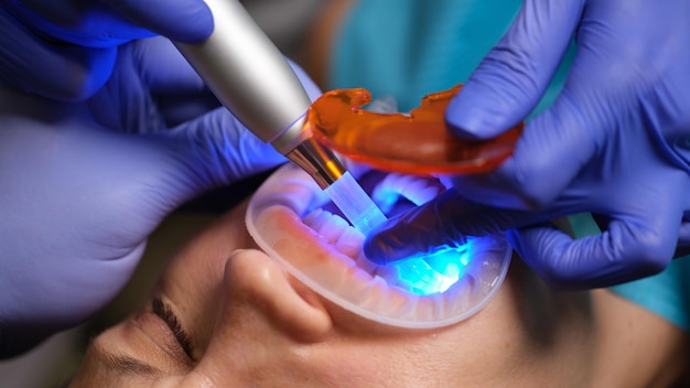 Restoration of teeth with fillingpolymerization lamp