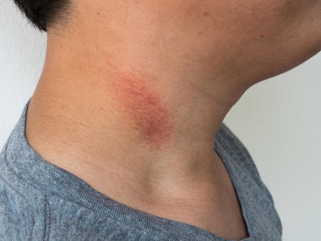 Ringworm tinea on the neck