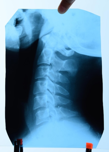 Foto röntgenfoto van de cervicale wervels röntgenbeeld van de cervische wervelkolom