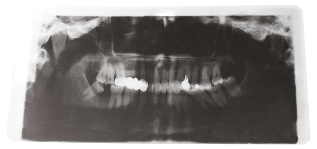 Röntgenfoto van menselijke kaken met tandkroon
