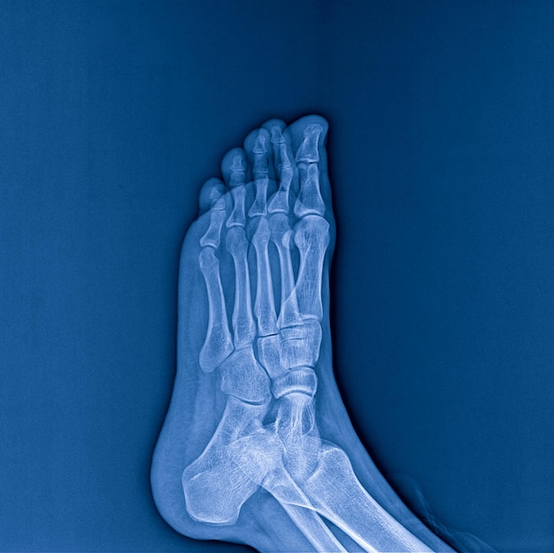 Röntgenstraal van voet op donkere achtergrondröntgenfoto