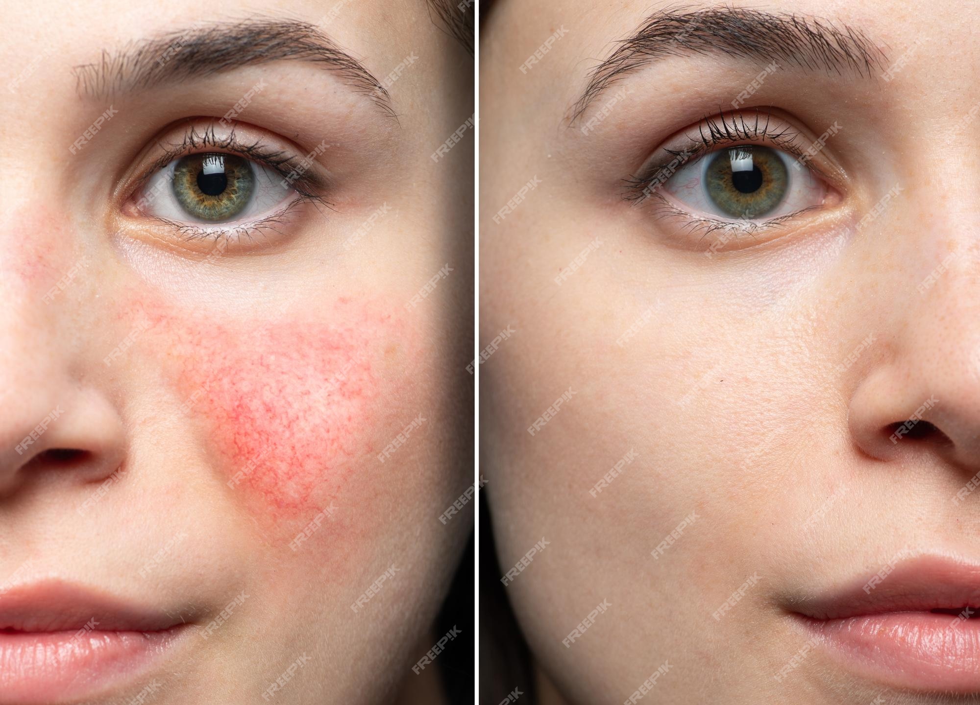 are rosacea and lupus the same?