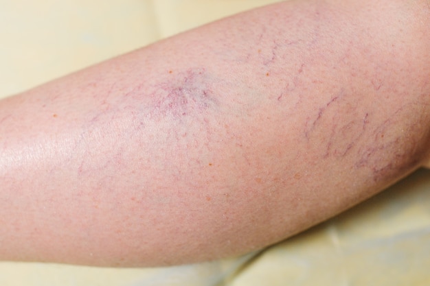 Rosacea or vascular mesh on women's legs