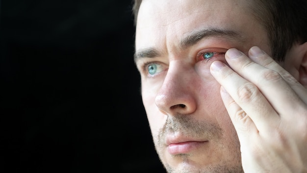 슬픈 남자는 결막염에 걸린 심각한 충혈된 적혈 눈을 만집니다.