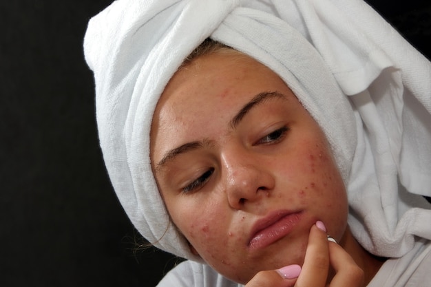 A sad teenage girl is looking at the pimples on her face in the mirror. Problematic skin in adolescents.