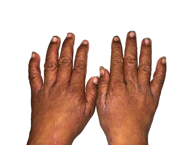 Photo scabies infestation in hands of southeast asian burmese child rough and dirty hands