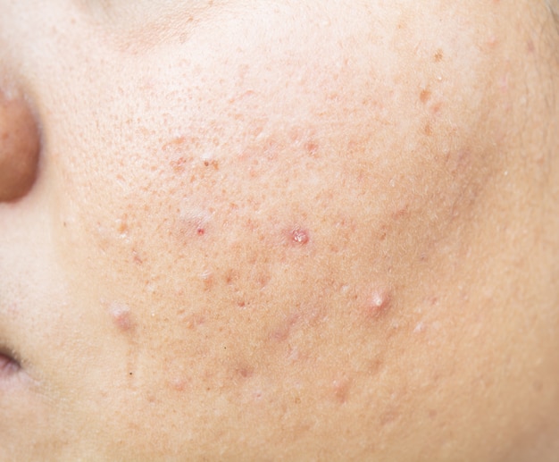 scar from acne on face  and skin problems and pores in teenagers