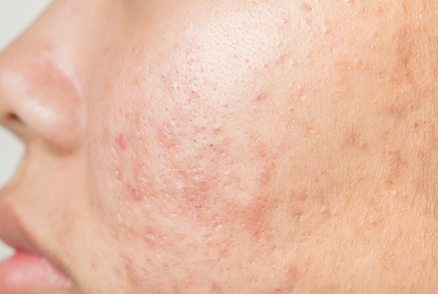 scar from acne on face