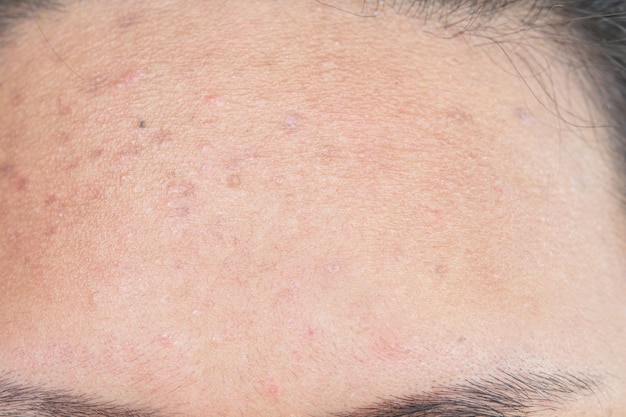 Photo scar from acne on face