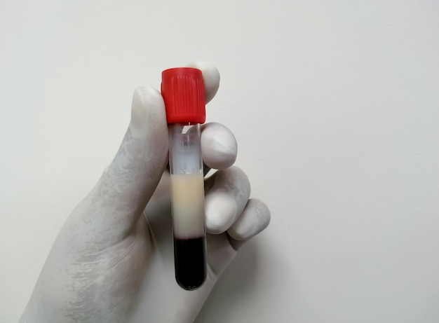 Scientist or Biochemist hold test tube with Lipemic blood sample.