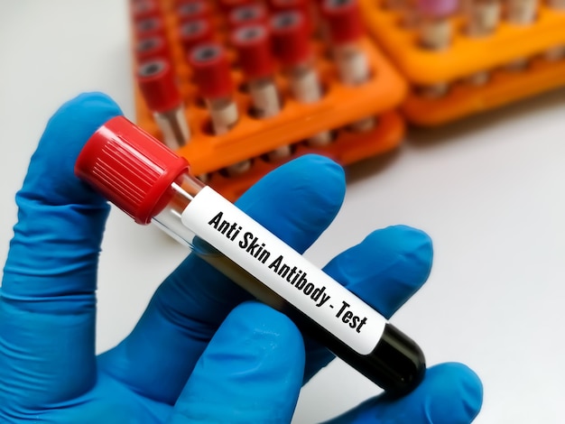 Scientist hand holding blood sample for Anti Skin Antibody test.