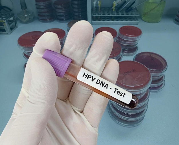 사진 과학자는 hpv dna 테스트를 위한 혈액 샘플을 보유하고 있습니다. 인간 유두종 바이러스 자궁경부암