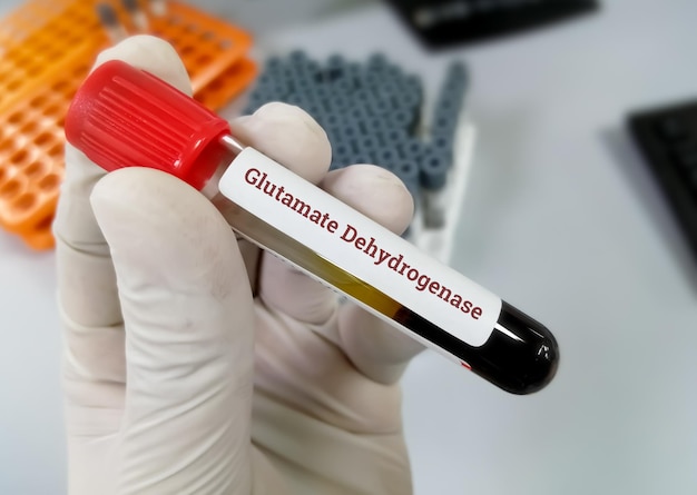 과학자는 글루타메이트 탈수소효소 또는 GLDH 테스트를 위해 혈액 샘플을 보유하고 있습니다.