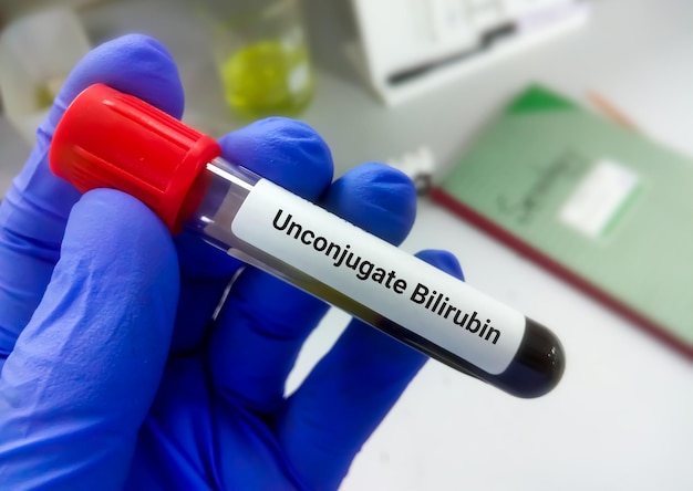 Scientist hold blood sample for Unconjugated Bilirubin test