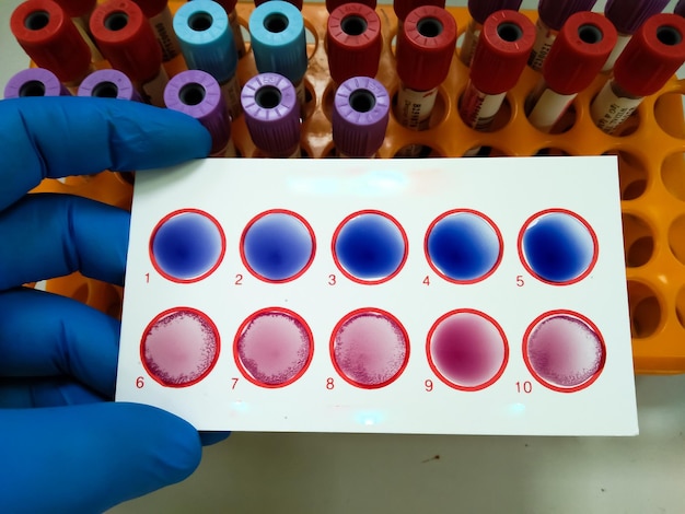 Scientist hold testing plate for Widal test by agglutination method with lab background.