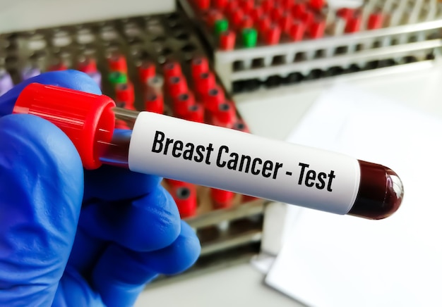 Ученый держит образец крови для теста на рак молочной железы CA153