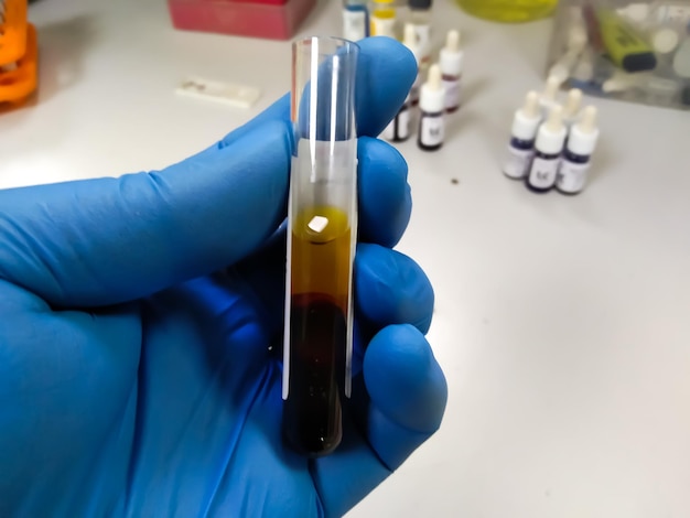 빌리루빈 테스트를 위해 고빌리루빈혈증 혈청의 혈액 샘플 튜브를 들고 있는 과학자. 황달 검사