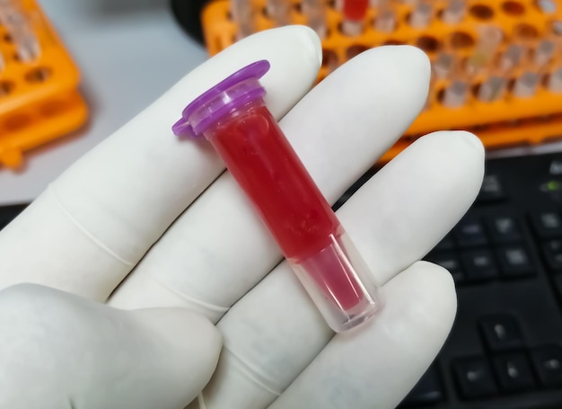 Scientist holding eppendorf with hemolyzed blood sample