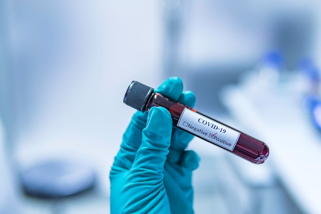 Scientist holding Test tube with blood sample for COVID19 testExperiment to detect virus was found in the blood