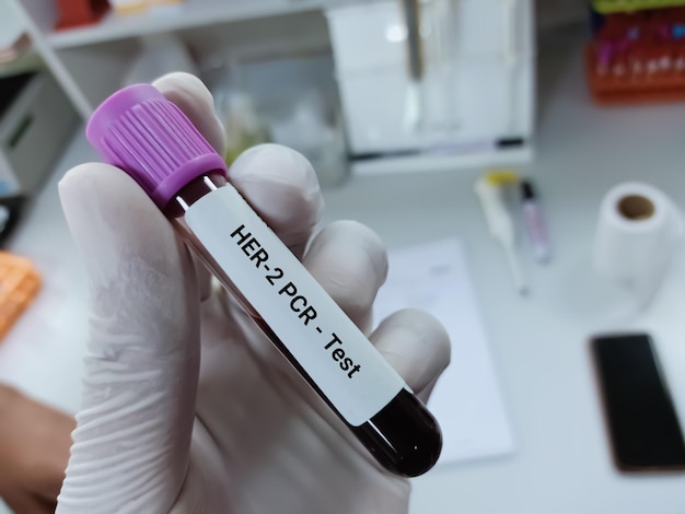 Ученый держит образец крови для ПЦР-теста Her-2 или рецептора 2 эпидермального фактора роста человека.