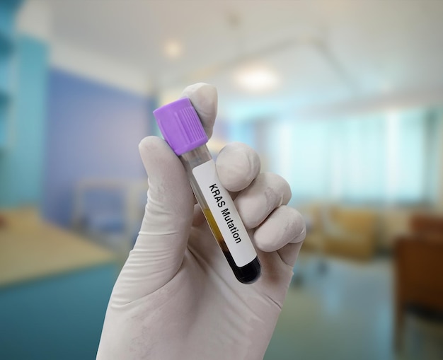 Scientist holds blood sample for KRAS mutation test with patient bed background Lung cancer test