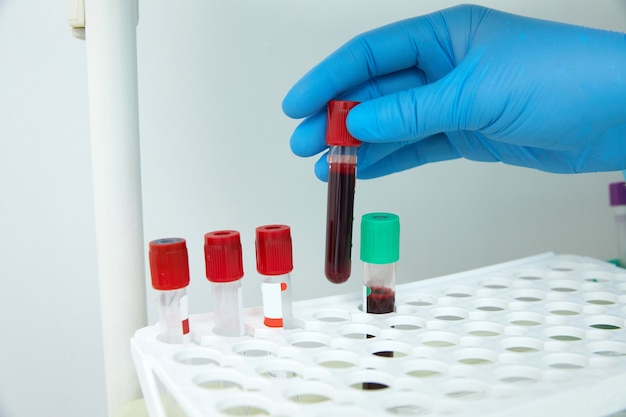 Photo scientist working with blood sample in laboratory