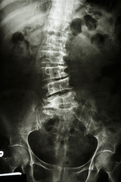 脊柱側弯症。腰椎のフィルムX線。正面図 。