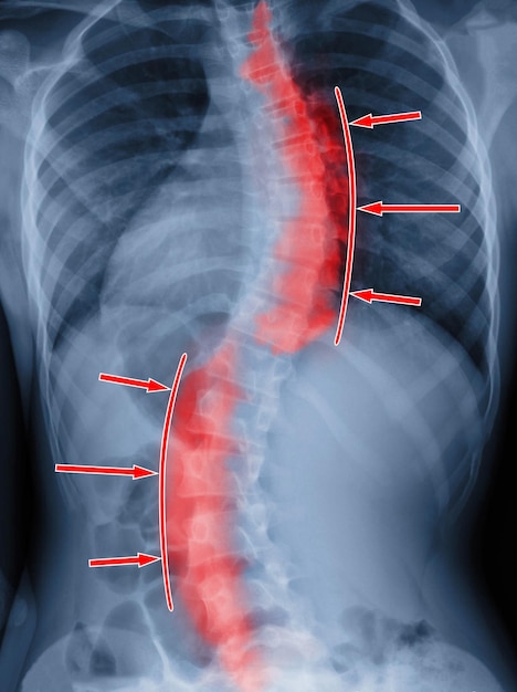 Scoliosis film xray show spinal bend in teenager patient Treatment concept