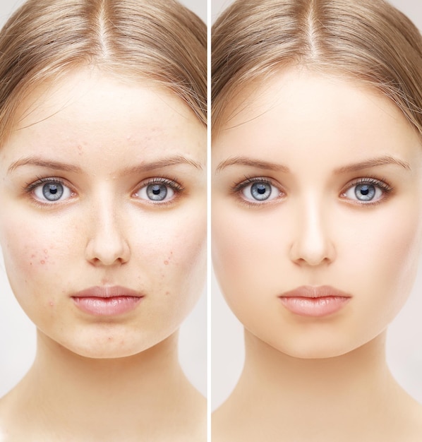 Photo the secret of makeup before after portrait of beautiful girl with problem and clear skin