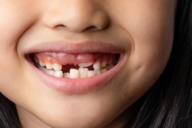 セレクティブフォーカスチャイルズの歯8歳の少女が赤ちゃんの切歯を失いました