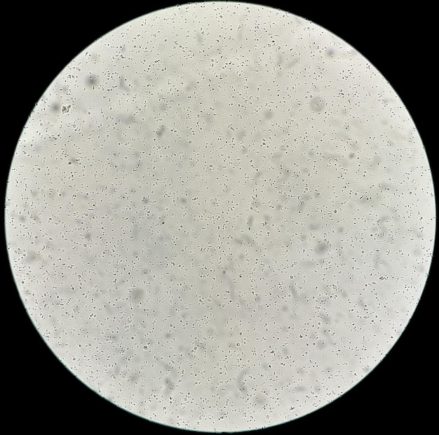 Semen analysis under microscopy showing Pyospermia or Leukocytospermia. Sperm analysis.