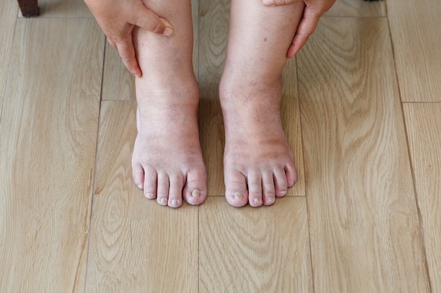 年配の女性の足と脚の腫れ