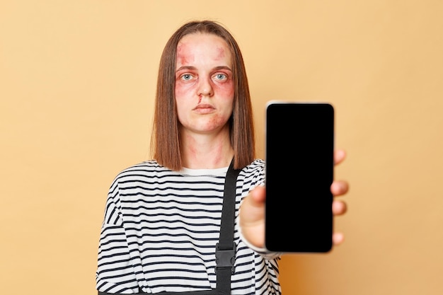 Фото Серьезная грустная женщина со многими травмами, получившая травмы дома, страдает от насилия в полосатой рубашке, показывая мобильный телефон с пустым пространством для копирования дисплея, изолированным на бежевом фоне