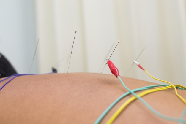 Photo shirtless man receiving acupuncture treatment