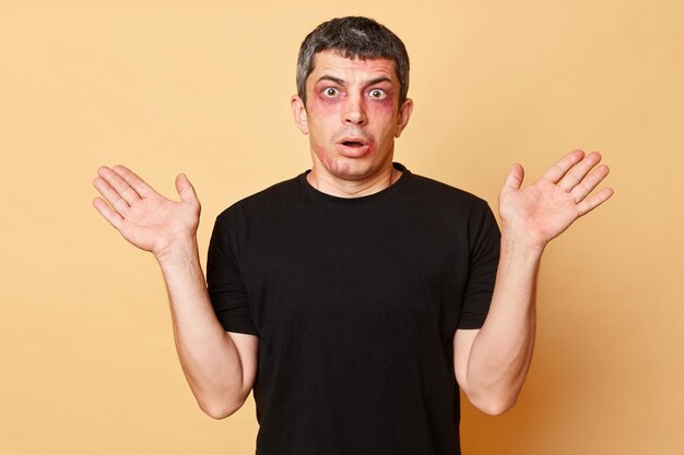 Shocked puzzled sufferer man in black Tshirt with bruises and abrasions on his face isolated over beige background raised his arms looking with big eyes full of fear