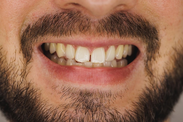 Foto shot van een onherkenbare man die lacht met tanden voordat hij orthodontist of tandheelkundig werk heeft gedaan.