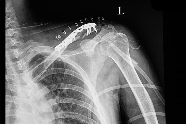 Photo a shouder film xray of a patient with fractured clavicle