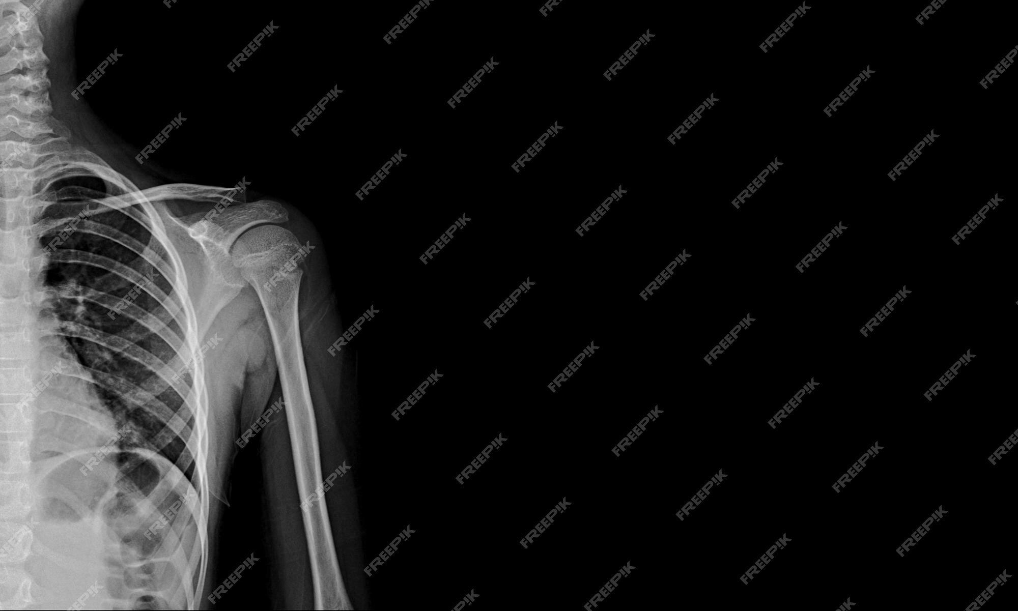 Premium Photo A shoulder of a person with a shoulder injury