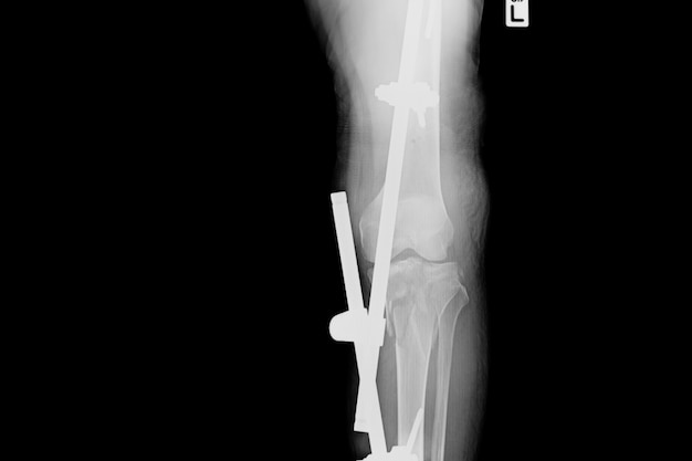 Show fracture tibia and fibula. X-ray image of fracture leg with implant external fixation.