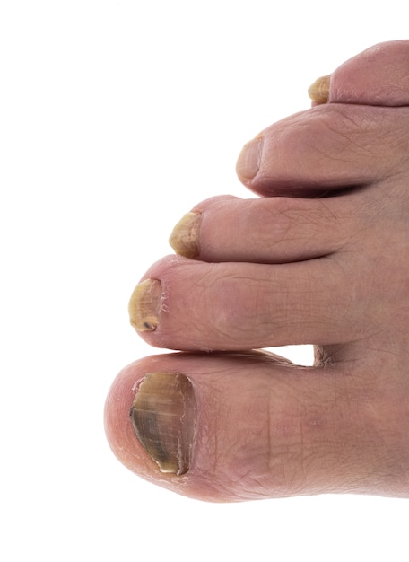 Фото Заболел ноготь на ноге грибком на большом пальце ноги