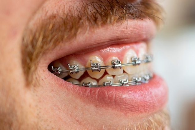 Side view of face of man with mustache and beard using orthodontic appliance.