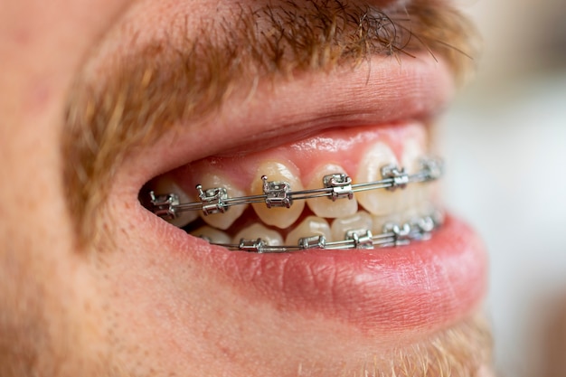 Foto vista laterale del volto dell'uomo con i baffi e la barba utilizzando apparecchio ortodontico.