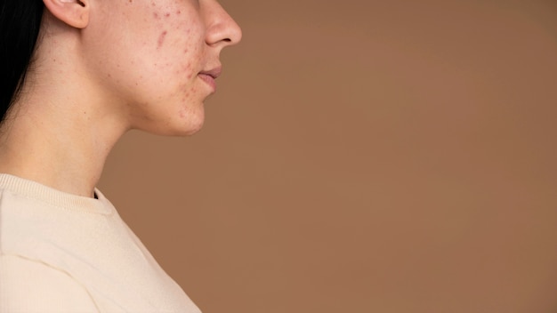 Photo side view young woman with acne