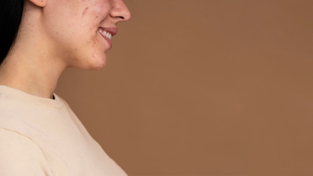 Side view young woman with acne